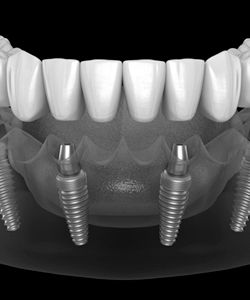 Digital image of all on four denture attaching to dental implants