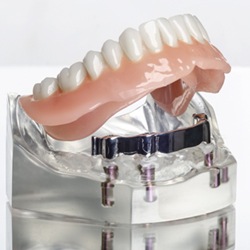 All-On-4 denture on lower arch