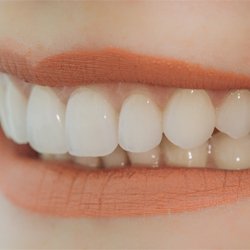 Closeup of flawless smile after dental bonding