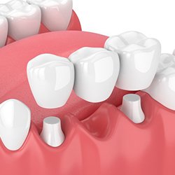 Animated dental bridge being placed in mouth