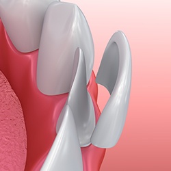 Animation of porcelain veneer placement