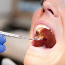 Dentist looking in a patient's mouth with a mirror after dental crown restoration