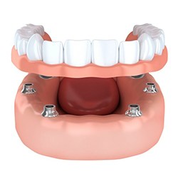 Diagram of dental implant-retained dentures