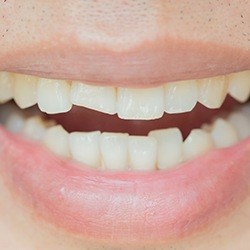 Closeup of smile with cracked tooth