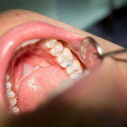 Closeup of smile during treatment to replace lost filling