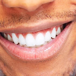 Tooth-colored filling