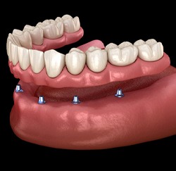 Dentures placed on dental implants