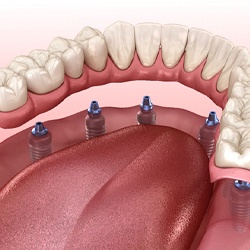 Animated dental implant dentures