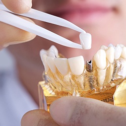 Dentist placing a dental crown on top of a dental implant in a model of the jaw