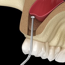 Animated smile during sinus lift procedure