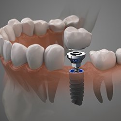 The three parts of a dental implant being placed in a patient’s jaw