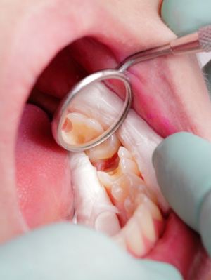 Dental mirror reflecting damaged tooth
