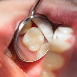 Closeup of tooth with metal free dental restoration
