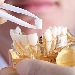 Model smile with dental implant supported dental crown restoration
