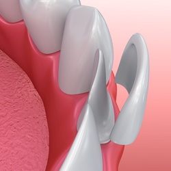 Animated smile during porcelain veneer placement