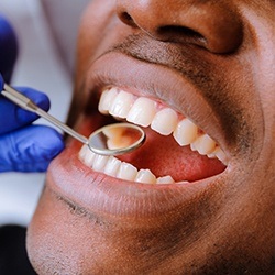 Closeup of patient examined after receiving dental sealants