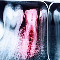 X-ray with damaged tooth highlighted red before root canal therapy