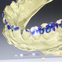 Digital bite impression on computer screen