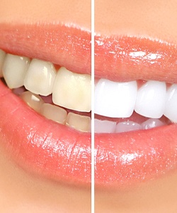before-and-after comparison of teeth whitening in Assonet