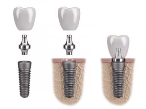 dental implant inserted in jawbone