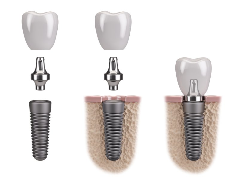 The Impact Dental Implants Can Have on Your Jawbone Density
