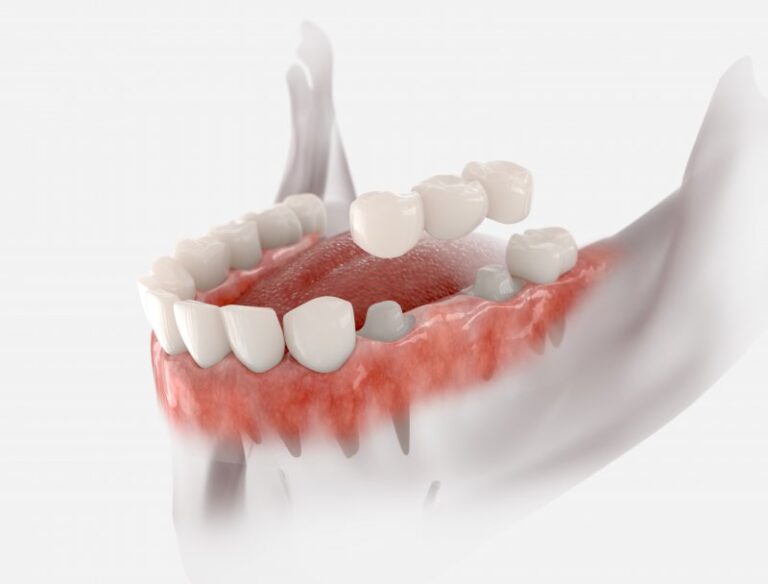 Can Dental Bridges Break? Woodside Dental Care